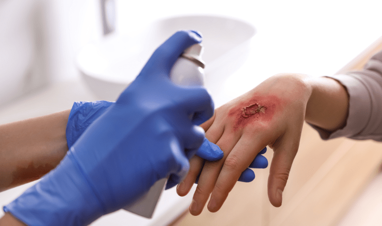 riverside burn injury lawyer